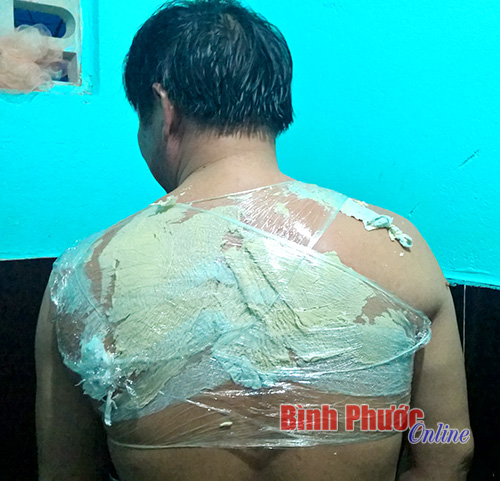 Sau khi mát xa, xoa bóp và bấm huyệt, khách hàng được đắp lên một loại bột mà các nhân viên chăm sóc sức khỏe gọi là thuốc để hút độc