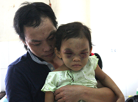 Bé gái 4 tuổi bị bạo hành đã được xuất viện và anh Tố tạm thời được giao quyền chăm sóc bé Ngân