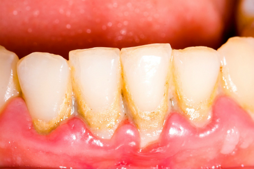 Kiểm soát ngăn ngừa sự xuất hiện của vôi răng và loại bỏ vôi răng là chìa khóa chính trong việc phòng ngừa bệnh nha chu. Ảnh: dream.