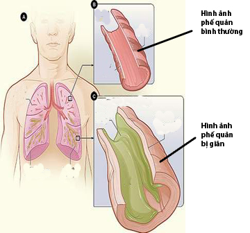 Phòng bệnh giãn phế quản