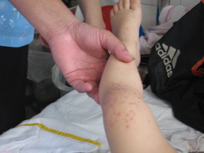 Phòng, chống dịch bệnh tay chân miệng tại hộ gia đình, các nhà trẻ, mẫu giáo