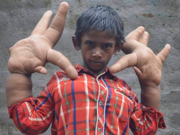Cậu bé 8 tuổi người Ấn Độ bị xa lánh vì có đôi tay "khổng lồ"