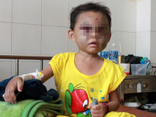 B&eacute; 4 tuổi cấp cứu nghi bị mẹ v&agrave; cha dượng h&agrave;nh hạ