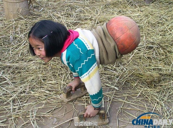Nghị lực tuyệt vời của "cô bé bóng rổ" phải cắt bỏ đôi chân