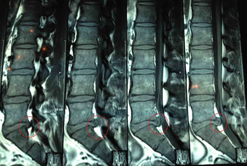 Ngừa nguy cơ thoát vị đĩa đệm