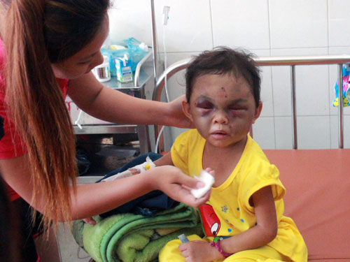 Nghi &aacute;n vợ chồng đ&aacute;nh con g&aacute;i chấn thương sọ n&atilde;o