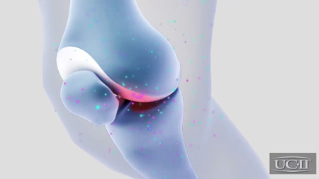 Lạm dụng thuốc giảm đau, khớp ngày càng ‘xuống cấp’