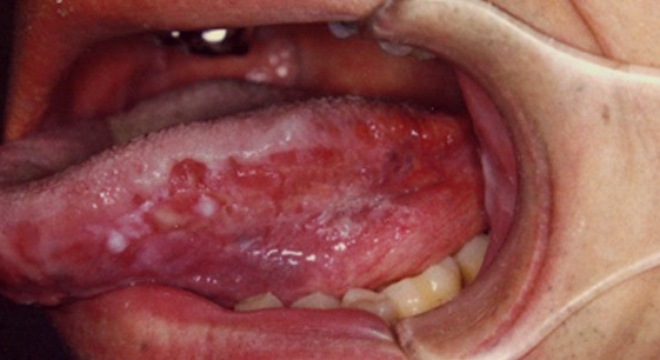Dấu hiệu bất thường ở lưỡi phải đi khám ngay kẻo ung thư