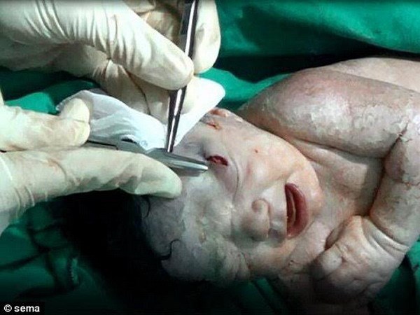 Cứu sống thành công em bé sơ sinh bị mắc mảnh đạn vào đầu
