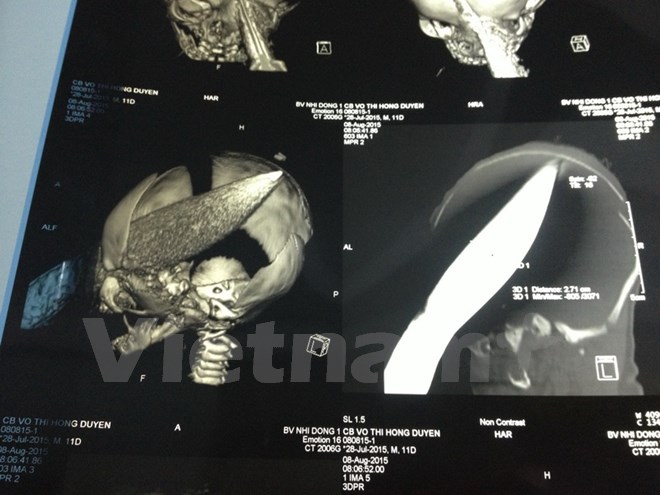 Cứu b&eacute; trai 11 ng&agrave;y tuổi bị người phụ nữ đ&acirc;m dao xuy&ecirc;n qua sọ
