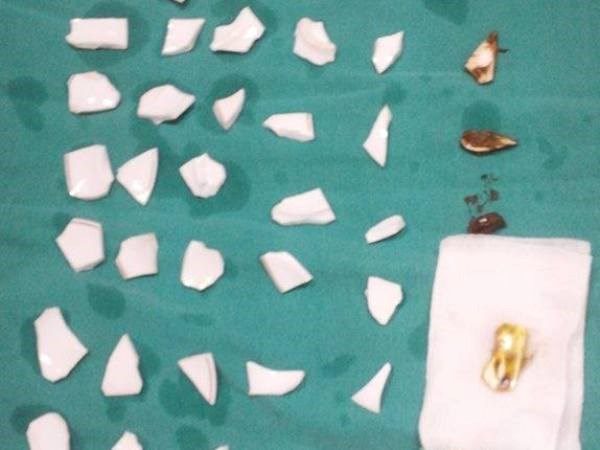 Phẫu thuật gắp 59 mảnh chén trong bụng một bệnh nhân