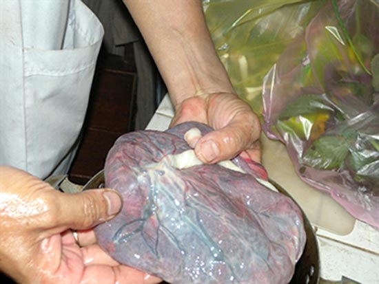 Hiểm họa thuốc nhau thai người