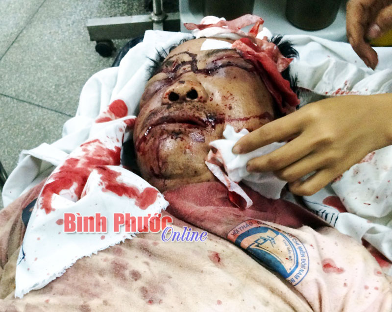 Cần sớm điều tra vụ một n&ocirc;ng d&acirc;n ở Lộc Ninh bị đ&aacute;nh d&atilde; man