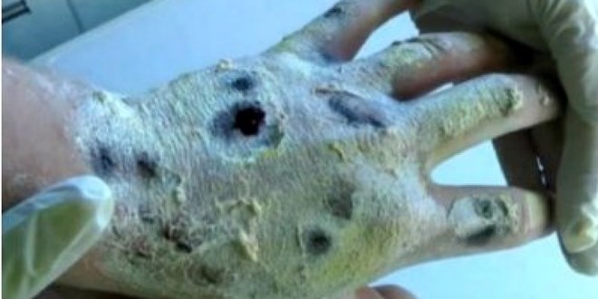 Cảnh báo về tác hại loại "ma túy cá sấu" nguy hiểm nhất thế giới