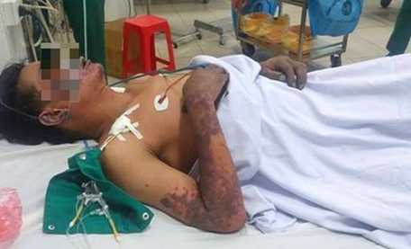 Ăn tiết canh lợn cắp nách, xuất hiện ban hoại tử khắp toàn thân