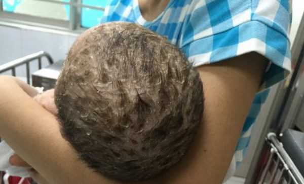 Bé trai nhiễm độc da toàn thân do mẹ tắm lá chữa thủy đậu