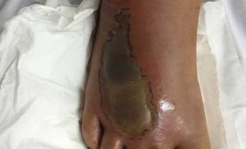 Mùa rắn sinh sôi: Nhiều trẻ bị rắn cắn phải nhập viện vì hoại tử chân