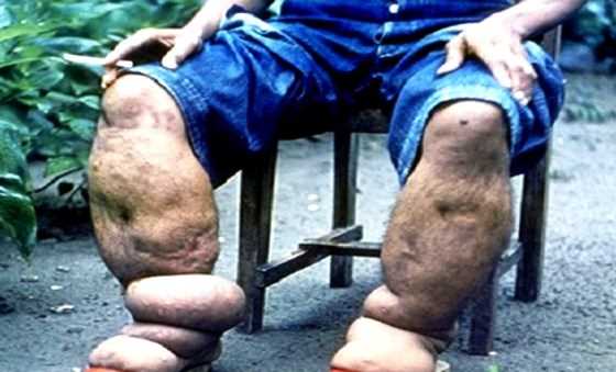 Tổ chức Y tế thế giới công nhận Việt Nam loại trừ được thêm một bệnh truyền nhiễm nguy hiểm