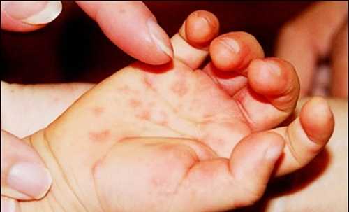 Tăng cường phòng chống dịch bệnh tay chân miệng