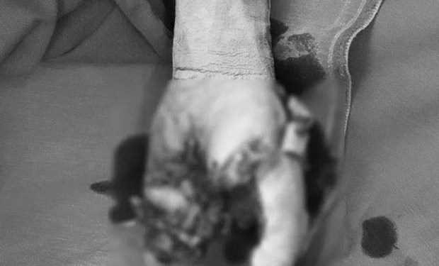 Trẻ 13 tuổi bị cắt cụt tay do vừa sạc pin vừa dùng điện thoại