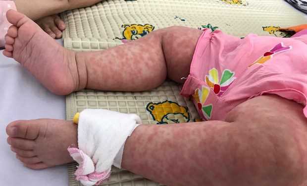 WHO: Bệnh sởi bùng phát ở quy mô mạnh nhất trong lịch sử nhân loại