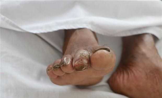 Không có trường hợp nhiễm vi khuẩn Whitmore như tin đồn