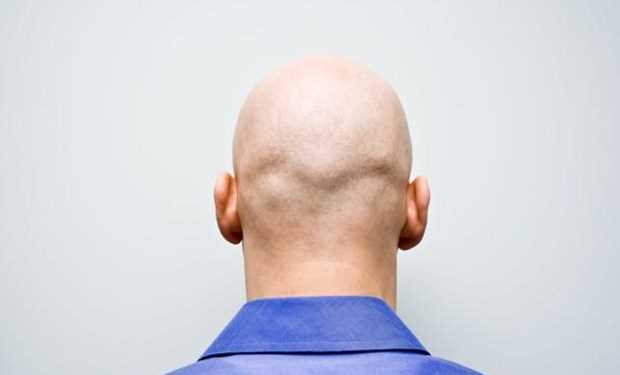 Ô nhiễm không khí có thể gây rụng tóc và hói đầu