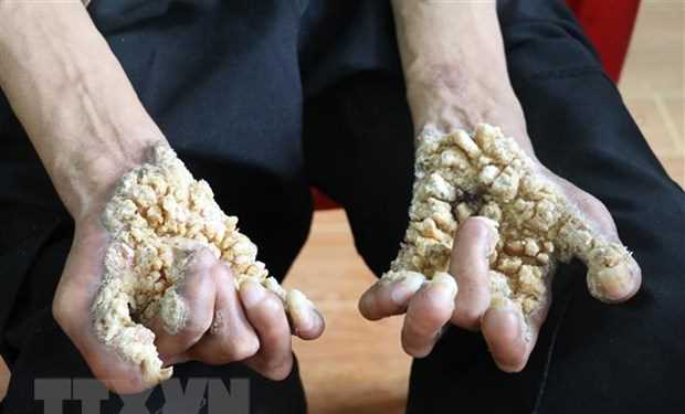 Ghi nhận trường hợp 'người cây' đầu tiên tại Việt Nam