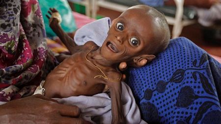Nạn đói khủng khiếp ở châu Phi: Bé 7 tháng tuổi cân nặng bằng trẻ sơ sinh