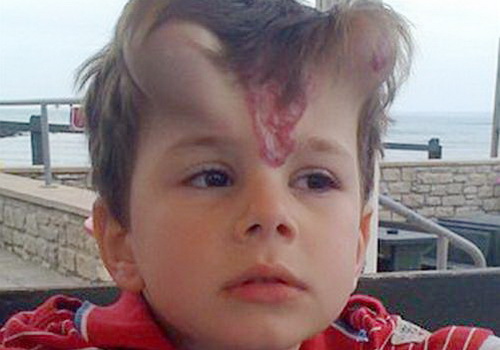 Cấy sừng để xóa bớt son