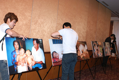 Nạn nhân da cam Việt Nam được phẫu thuật tại Hàn Quốc