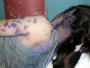 Bệnh sốt rét, sốt xuất huyết, tay chân miệng tăng đột biến