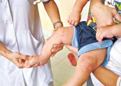 Phát hiện 102 trẻ em bị mắc bệnh tay chân miệng