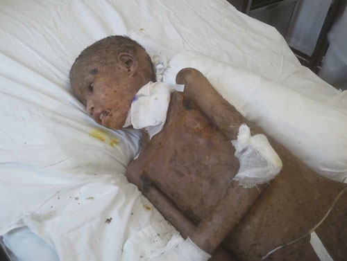 Khó cứu được đôi mắt nạn nhân 'ma rừng'