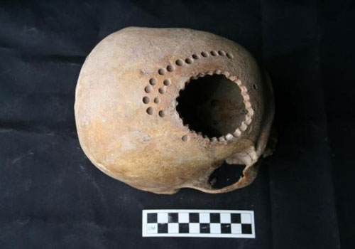 Phẫu thuật mở sọ hơn 1.000 năm trước