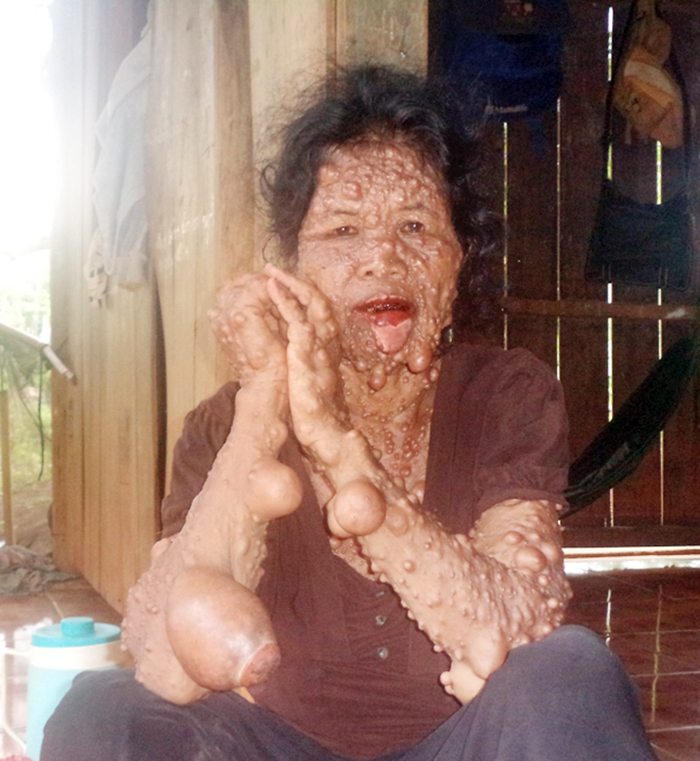 Người phụ nữ bị bệnh lạ cần được giúp đỡ