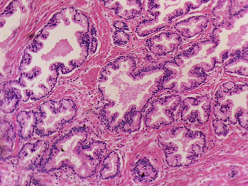 Có thể nhận biết sớm ung thư tuyến tiền liệt