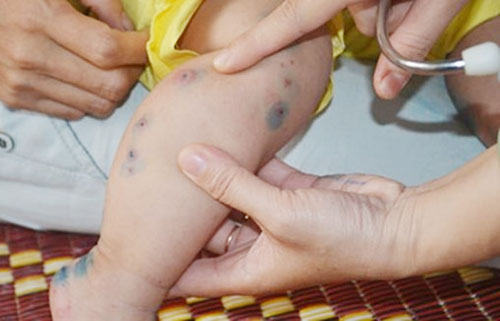 Quý 1, toàn tỉnh xảy ra 123 ca chân - tay - miệng