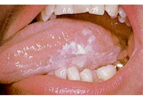 Dấu hiệu nhận biết ung thư lưỡi