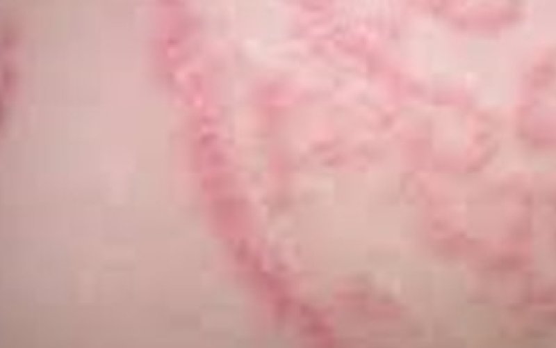 WHO lần đầu ti&ecirc;n x&aacute;c định c&aacute;c bệnh về nấm l&agrave; mối đe dọa với sức khỏe con người