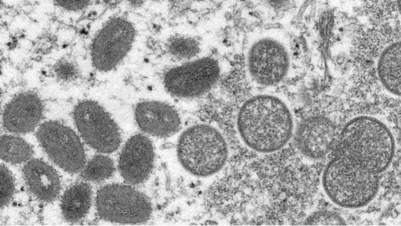 Bệnh đậu mùa khỉ: Gần 92.000 ca nhiễm và 167 ca tử vong trong 2 năm