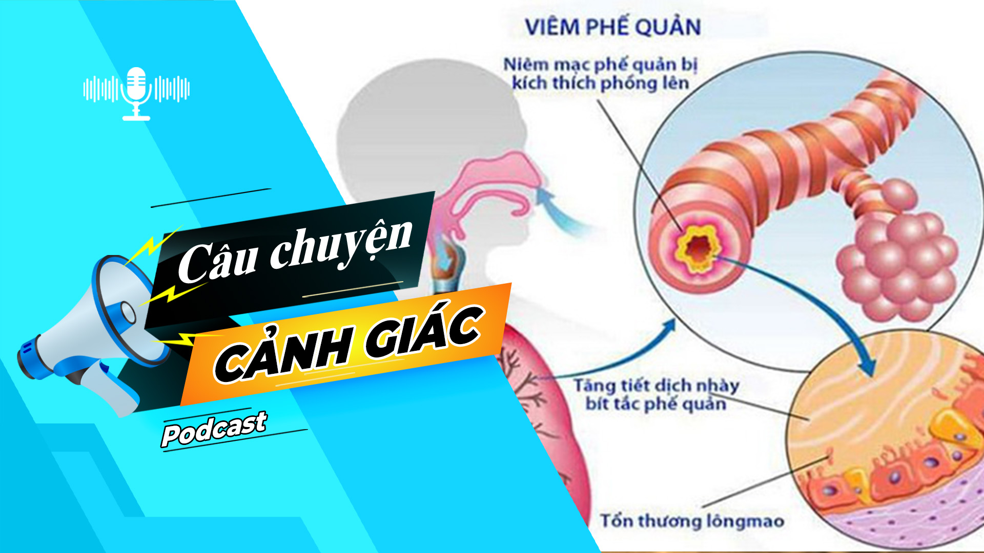 Cảnh giác với bệnh viêm phế quản | Câu chuyện cảnh giác