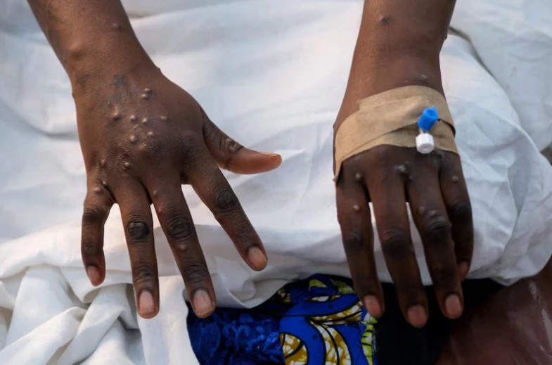 Số ca mắc bệnh đậu mùa khỉ ở Châu Phi tăng 500%