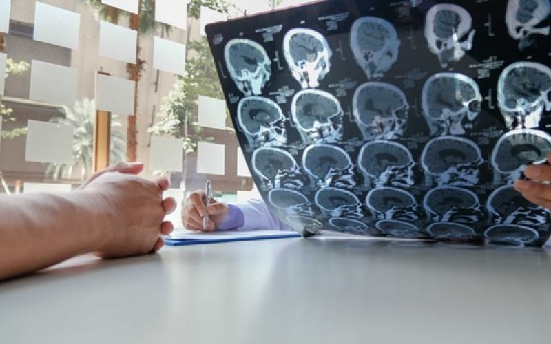 AI giúp chẩn đoán sớm và tìm ra phương pháp điều trị cho người đột quỵ