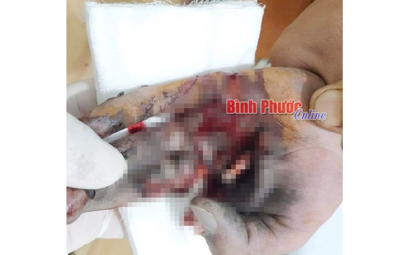 Vừa sạc vừa chơi game, một thanh niên bị điện thoại nổ nát bàn tay