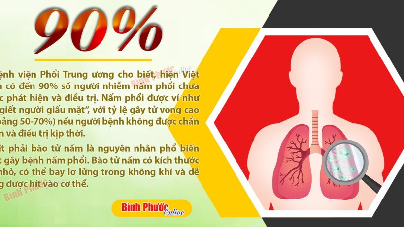 Số người Việt không biết bị nhiễm nấm phổi chiếm đến 90%