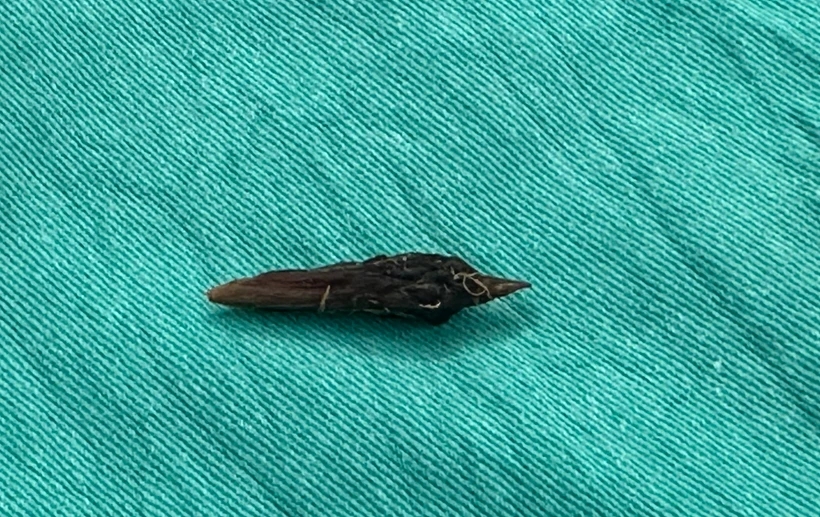 Người phụ nữ bị thủng, hoại tử ruột non vì nuốt phải hạt táo đỏ