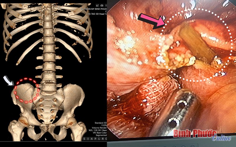 Bình Phước: Người đàn ông bị xương cá đâm thủng thành ruột