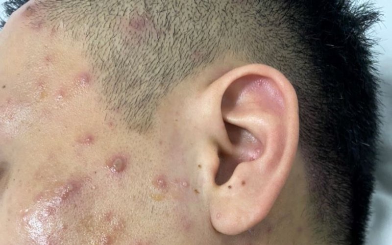 Chăm s&oacute;c người mắc bệnh thuỷ đậu thế n&agrave;o để tr&aacute;nh biến chứng