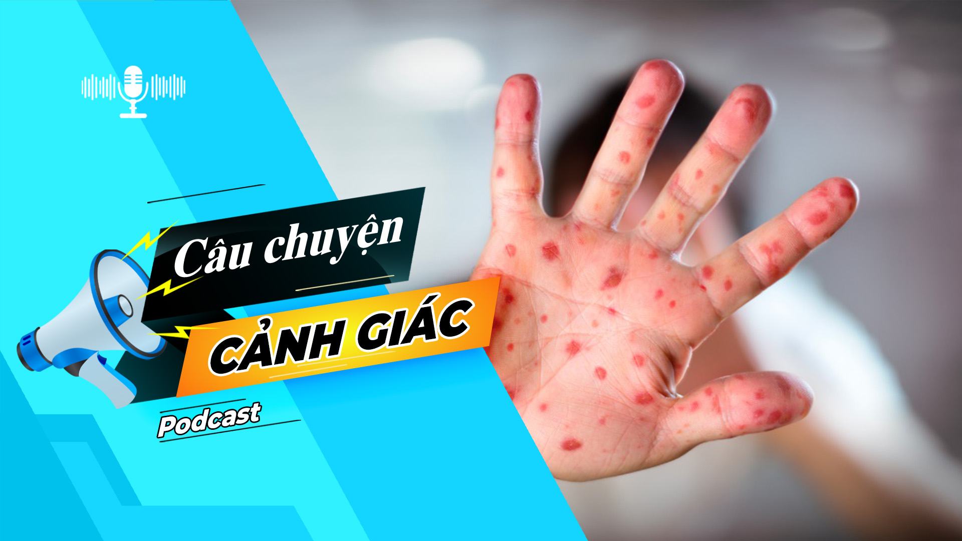 Cẩn trọng với biến chứng của bệnh sởi | Câu chuyện cảnh giác